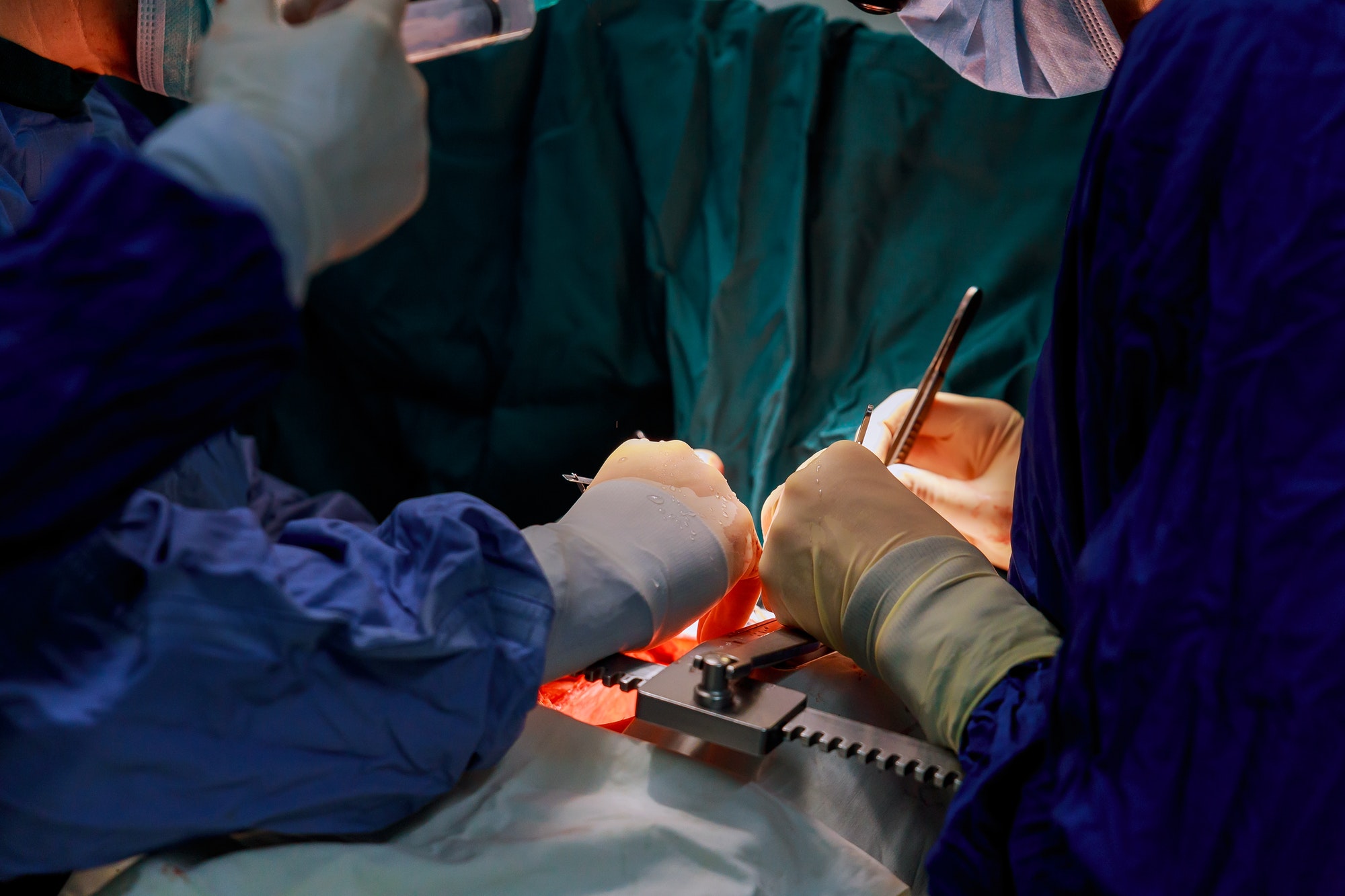 Doctor doing heart operation Donor Heart Procurement for Cardiac Transplantation