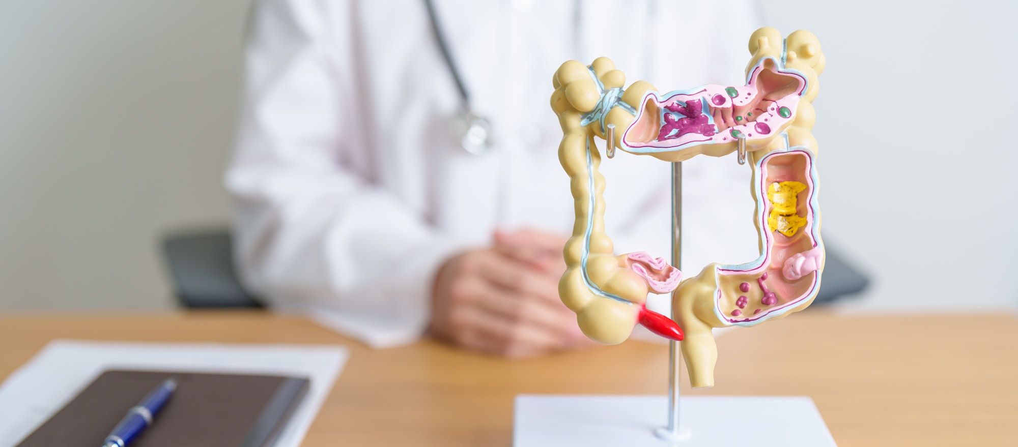 Doctor with human Colon anatomy model. Colonic disease